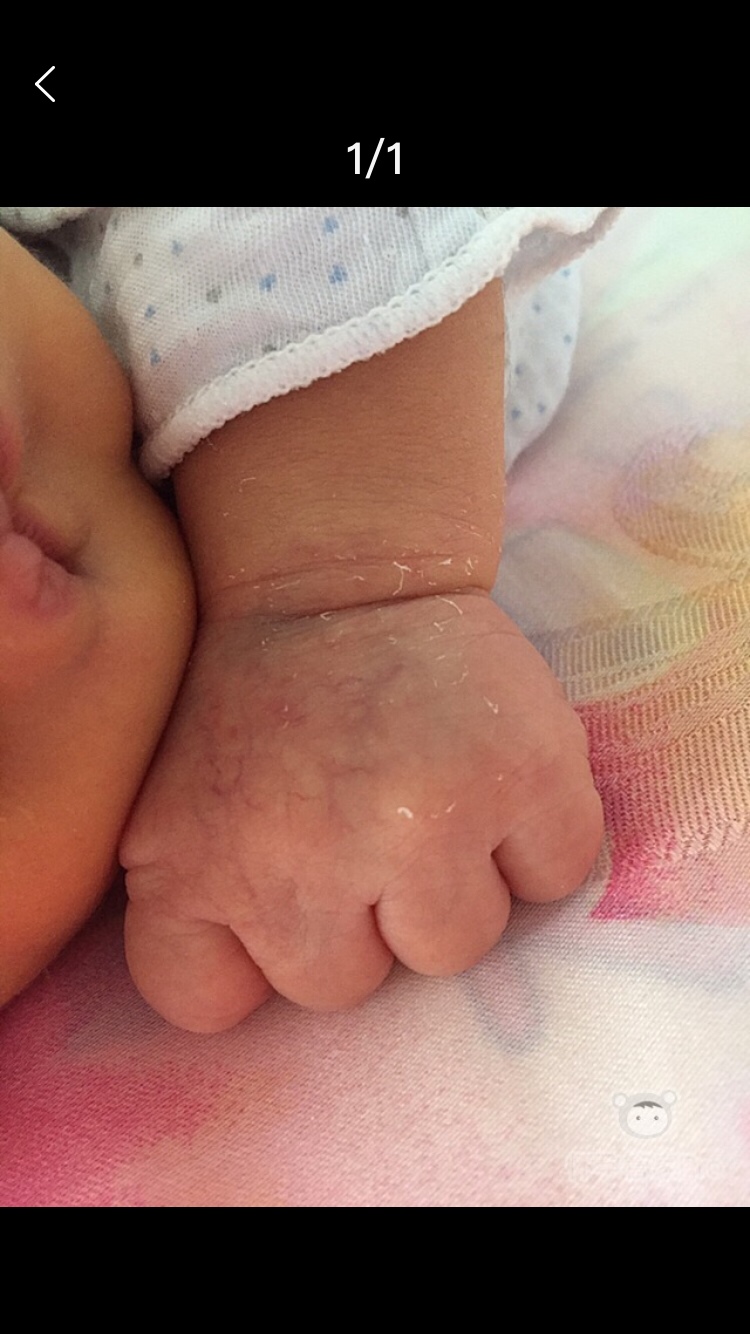 宝妈们 麻烦帮我看一下我家宝宝手上是什么qim