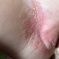 请问大家宝宝屁股这样是怎么回事？前几天出去玩水回来就开始红了，是感染了还是尿不湿造成的？