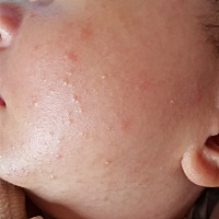 宝宝脸上有很多小点，有知道怎么处理的吗？