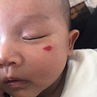 宝宝脸上有血管瘤会自己淡掉吗？