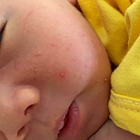 这个什么呀，宝宝出生21天 这个是不是湿疹，有什么办法消除没有