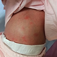 有宝妈知道宝宝身上起的这个红疙瘩是怎么回事吗   四肢肚子最多  脸上没有  后背就有两颗