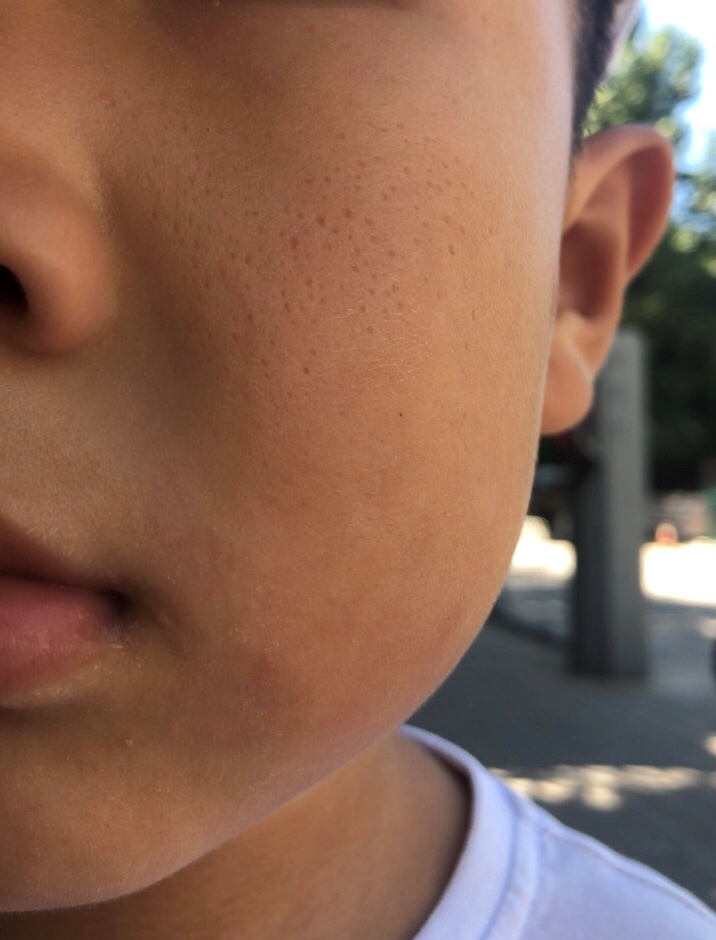 宝宝脸上的小坑有得治吗？能治好吗？
