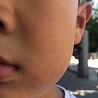 宝宝脸上的小坑有得治吗？能治好吗？