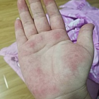 怀孕后期了手心发红，发热问下你们这种情况正常吗？你们有这种情况吗？