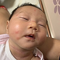 一早醒来就这样了，不知道蚊子咬的还是啥，严重起来了，紫草膏擦了也不见好