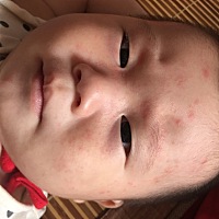 急急急！宝宝发烧几天烧退了就出了这个红色疹子，昨晚睡之前给他擦过药了今天也没有一点好转，有宝妈知...