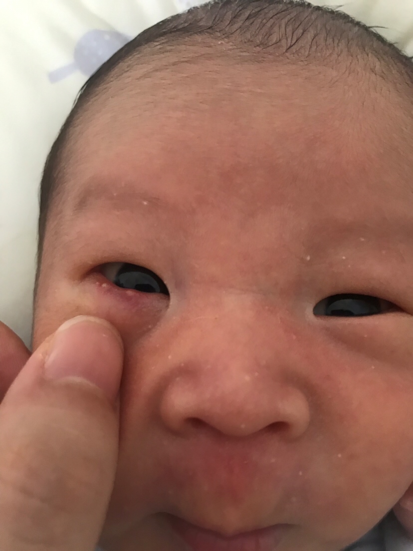 求助…宝宝眼睛下面长白点什么原因？？？