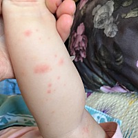宝妈们，我家孩子九个月胳膊上出红疹子是怎么回事，严重吗