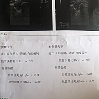 髋关节发育不良。医生说满三月复查。没采取治疗。会不会越来越严重。有没有宝妈知道这种情况的。
