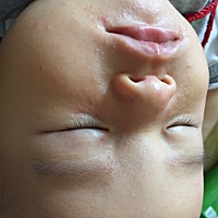 姐妹们，帮帮忙看看宝宝脸上长这些是什么长了第三天了，该如何是好，急