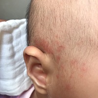 各位宝妈，有谁知道这个是痱子还是湿疹啊？去医院医生说病毒感染引起的，不用管。可是现在越来越严重了...