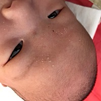 宝妈们这是胎记吗，怎么治疗啊，好担心长大