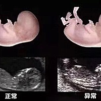 什么是NT检查？[疑问] 孕妈咪一定要懂的第一次胎儿排畸！ ——NT检查[嘿哈] 筛查胎儿畸形，染色体问题[...