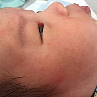 我家孩子得湿疹了，都一个多星期了，怎么办呀，摸了两个药膏都不好使，各位宝妈谁有好使的药膏推荐一下...