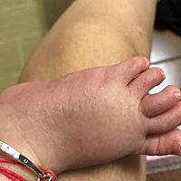 我家宝宝5个月，女孩。前面手脚冰凉有时发红或发紫，还伴有红疹一样的东西，吃奶还可以。去皮肤诊所说不...