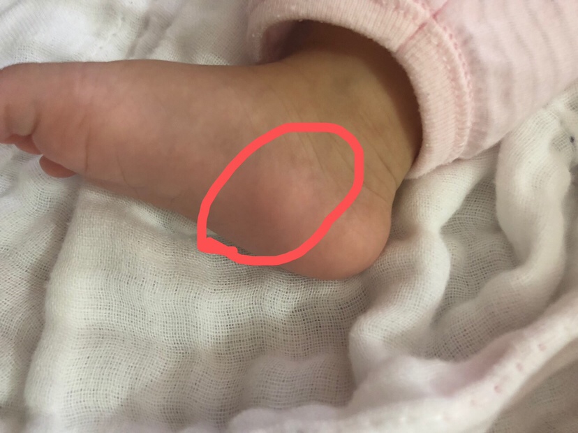 有宝妈知道三个月的宝宝脚丫内侧有个小鼓包是怎么回事吗？