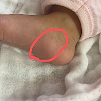 有宝妈知道三个月的宝宝脚丫内侧有个小鼓包是怎么回事吗？