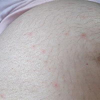 我这个是不是？妊娠期胆汁淤积症呢？ 各位宝妈，帮我看一下，有没有同样的症状？这是什么呢？肚皮会...