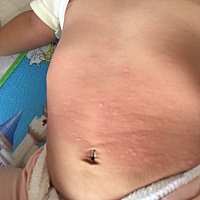 各位宝妈，我宝宝10个月，突然早上起床起了这些疹子，有宝妈知道是什么来的吗？