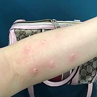 父母堂上坐，儿女绕膝行 这大概就是最大的幸福~为了宝贝受一切的疼都是值得的。第一次封闭抗体阴性治疗i...