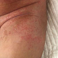 宝宝这是起的痱子还是湿疹啊。是不是尿不湿过敏啊。可是从出生一开始就一直用的这个牌子