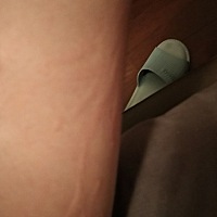 你们产后有出现这种情况吗？这是湿疹？一到晚上就有，特别痒，碰到热水出来的更多，该怎么办？今天产后...