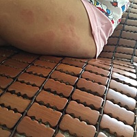 朋友们知道这是怎么了吗？昨天晚上发的。屁股和大腿上都是。  是两周半的小朋友