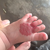 刚开始以为是胎记。没想到后面别人说这个是血管瘤 心都碎了 不知道严不严重 要怎么治疗？