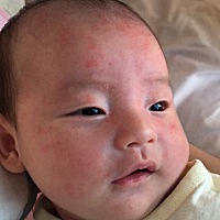 这是什么，好像痱子，宝宝本来白白净净的一张脸，一热起来就抓挠，满脸都是这种小疙瘩，怎么来的，怎么...