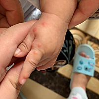 各位宝妈”这个到底是不是蚊子咬的？就长这只手，本来一颗”现在出现好几颗了。😢求助