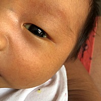 宝宝眼睛里好像长了一个肉球 不知道是什么?有知道的宝妈吗