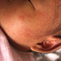 各位宝妈们   婴儿脸上起的这是属于湿疹吧  有什么办法吗？  头皮里  耳朵  下巴   也开始有了  怎么办 ...