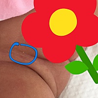 这几天发现1个月的宝宝外阴和大腿根附近起了一个白色脂肪粒。有没有类似情况？是湿疹吗