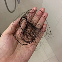 产后掉发让我怀疑人生，额头两侧已经掉秃了，请问大家有没有什么办法能制止？