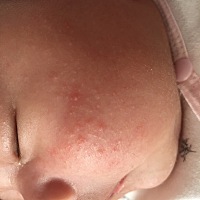 各位宝妈、 有没有什么治疗湿疹的好方法？ 急急急！！！