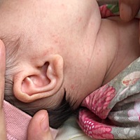宝妈们，帮忙看看宝宝脖子和脸上长的什么东西？擦什么可以好呢