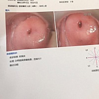 上个月去做孕前检查阴超怀疑宫腔黏连？有点盆腔积液！宫颈囊肿也有点，医生说回家试着怀！怀不得再说！...