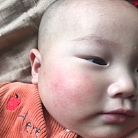 这两天一直感觉宝宝脸红我还以为睡觉睡得 然后右边一直在红左边不热了就不红了 请你们看下是不是过敏了