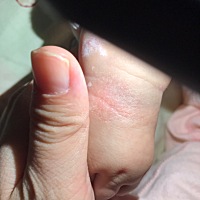 我想问下大家，脸上和手上长这种是什么？涂了润肤乳和湿疹膏都没用 g