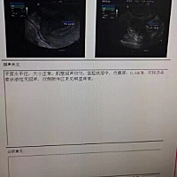 周期28天，每次七八天。周期第11天卵泡，1.19 ✖️1.18。图一是今天第14天，上午查没看到卵泡。图二和图...
