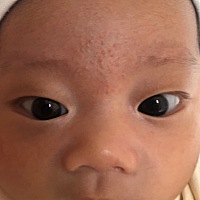 宝宝额头长这样的类似粉刺的东西怎么办？用的是强生婴儿擦脸霜。