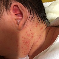 黄疸347.5住院照了四天蓝光回来，全身皮肤都照脱皮了，声音哭哑了，还长了湿疹…… 现在回来三天，声音...
