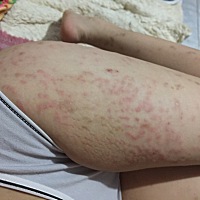 有没有生完孩子的宝妈和我一样 大腿上长了好多小红痘 痕痒……你们都好了吗……用的什么呀……我都...
