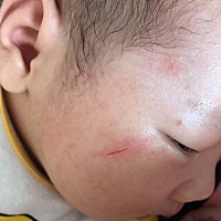 自己把自己脸抓破了，心疼死了，能用碘伏消毒么