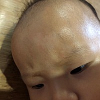 宝宝额头上长了一块像白斑一样的东西 去医院检查了不是白癜风 这个有在扩散慢慢变大 医生说不用管它 可...