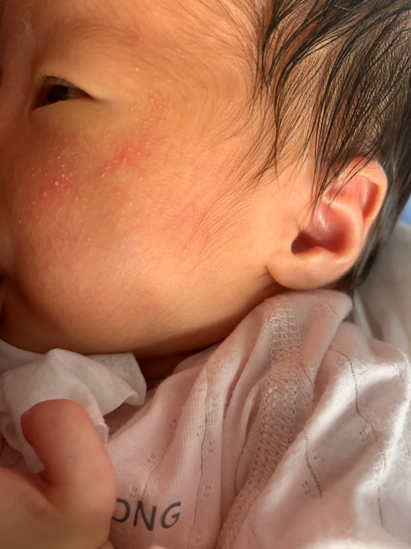 请问孩子七天脸上起小白点是为什么呢？