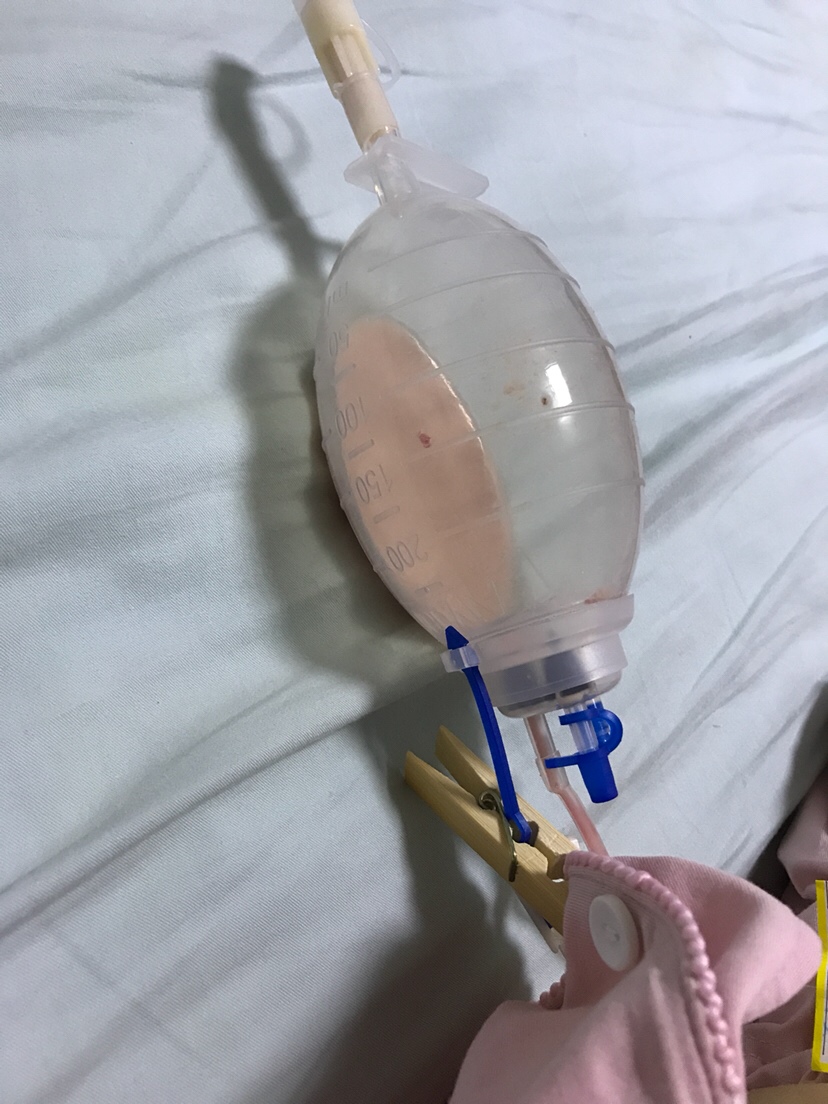 我儿子已经五个半月了，之前躲过了乳腺炎，没想到。这个时候居然来的这么猛。宝宝大了，人也懒了，以前每天晚上还爬起来吸奶。后来觉得涨点也没啥，就越来越懒，不想吸奶。刚开始只是有点堵，我在乡下找了个催乳师，无良催乳师一通瞎搞，回来吸奶就开始吸到粉粉的血水，催奶师说这是因为畅通了才会有血水，怪自己没有经验，听信了她的话。结果第二天就开始全堵，反复高烧40度，b超显示一大块脓在乳房深处，我立刻回城里大医院，挂水挂了6天，一点成效也没有，医生建议开刀取脓。本来以为开刀就好了。在医院呆了四五天，今天出院。结果还是插着引流管出院，引流管