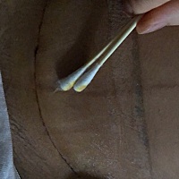 剖腹产第十天 感觉还是好害怕