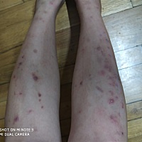 各位你们有没有这样的情况？腿上好痒，这到底是什么